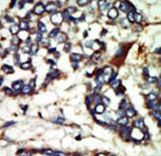 Formalin-fixed and paraffin-embedded human cancer tissue reacted with the primary antibody, which was peroxidase-conjugated to the secondary antibody, followed by DAB staining. This data demonstrates the use of this antibody for immunohistochemistry; clinical relevance has not been evaluated. BC = breast carcinoma; HC = hepatocarcinoma.