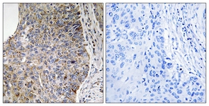 IHC of paraffin-embedded human lung carcinoma tissue, using NEK7 Antibody. The sample on the right was incubated with synthetic peptide.