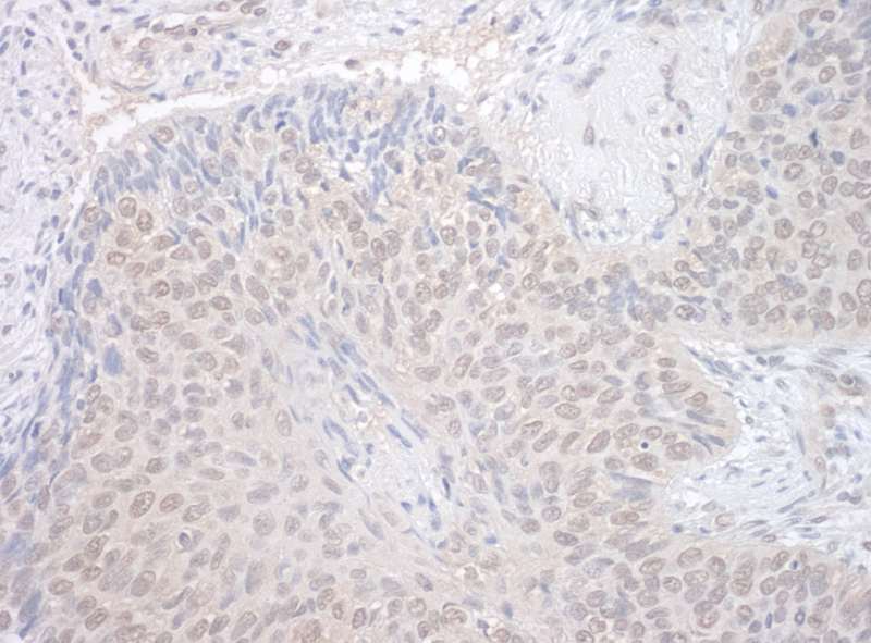 Detection of Human NEK7 by Immunohistochemistry. Sample: FFPE section of human non-small cell lung cancer. Antibody: Affinity purified rabbit anti-NEK7 used at a dilution of 1:250.