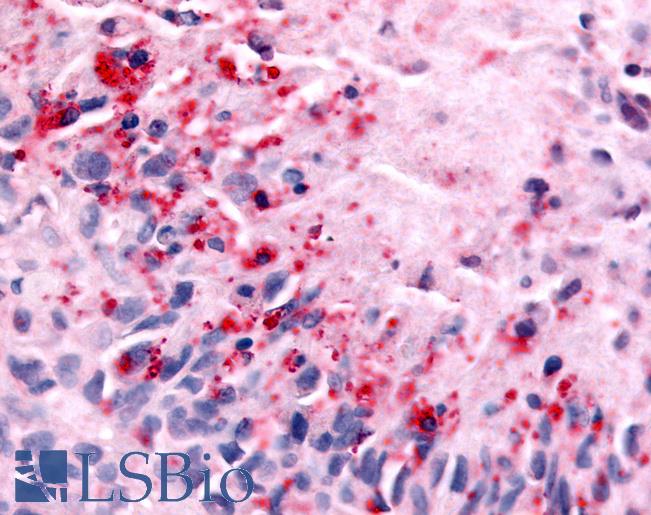 Anti-NEK7 antibody IHC of human Brain, Glioblastoma. Immunohistochemistry of formalin-fixed, paraffin-embedded tissue after heat-induced antigen retrieval.
