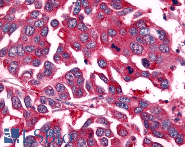 Anti-NEK7 antibody IHC of human Colon, Carcinoma. Immunohistochemistry of formalin-fixed, paraffin-embedded tissue after heat-induced antigen retrieval.