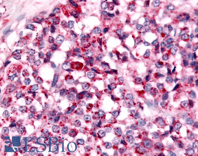 Anti-NEK7 antibody IHC of human Breast, Carcinoma. Immunohistochemistry of formalin-fixed, paraffin-embedded tissue after heat-induced antigen retrieval.