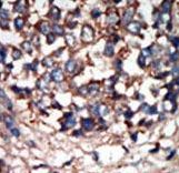 Formalin-fixed and paraffin-embedded human cancer tissue reacted with the primary antibody, which was peroxidase-conjugated to the secondary antibody, followed by AEC staining. This data demonstrates the use of this antibody for immunohistochemistry; clinical relevance has not been evaluated. BC = breast carcinoma; HC = hepatocarcinoma.