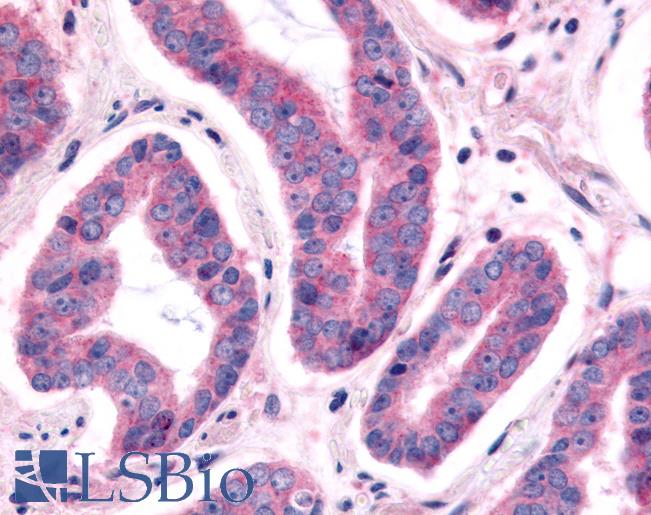 Anti-NEK9 antibody IHC of human Prostate, Carcinoma. Immunohistochemistry of formalin-fixed, paraffin-embedded tissue after heat-induced antigen retrieval.