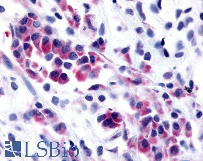 Anti-NEK9 antibody IHC of human Breast, Carcinoma. Immunohistochemistry of formalin-fixed, paraffin-embedded tissue after heat-induced antigen retrieval.