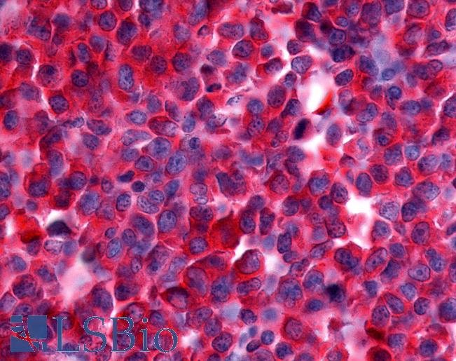 Anti-NEK9 antibody IHC of human Lymph Node, Non-Hodgkins Lymphoma. Immunohistochemistry of formalin-fixed, paraffin-embedded tissue after heat-induced antigen retrieval.