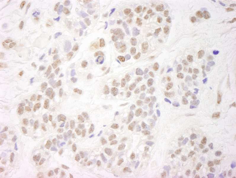 Detection of Human NELFA by Immunohistochemistry. Sample: FFPE section of human breast carcinoma. Antibody: Affinity purified rabbit anti-NELFA used at a dilution of 1:250.