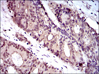 IHC of paraffin-embedded colon cancer tissues using WHSC2 mouse monoclonal antibody with DAB staining.