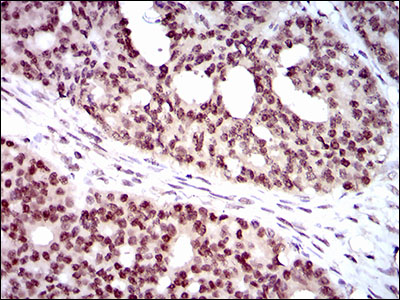 IHC of paraffin-embedded ovarian cancer tissues using WHSC2 mouse monoclonal antibody with DAB staining.