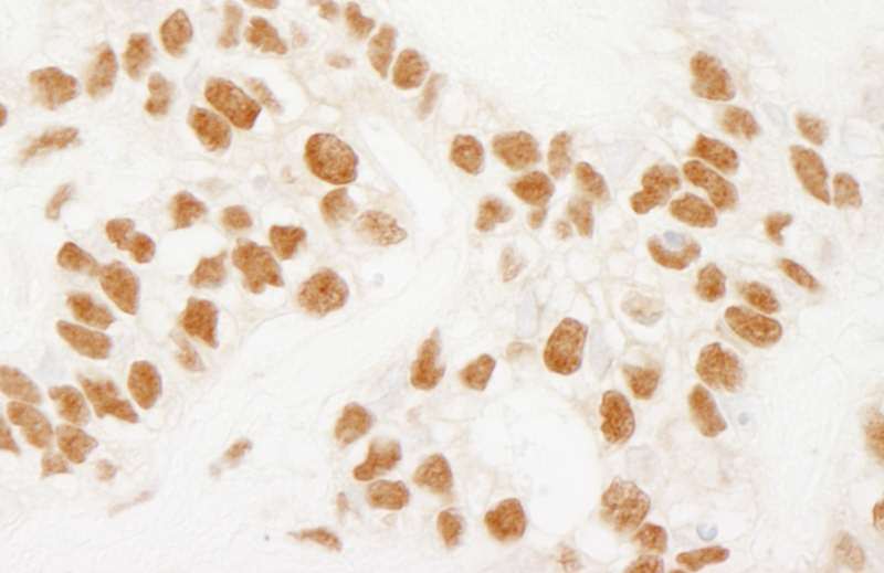 Detection of Human NELFE by Immunohistochemistry. Sample: FFPE section of human ovarian carcinoma. Antibody: Affinity purified rabbit anti-NELFE used at a dilution of 1:1000 (1 ug/ml). Detection: DAB.