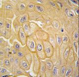 Formalin-fixed and paraffin-embedded human lung carcinoma tissue reacted with MCK10 antibody , which was peroxidase-conjugated to the secondary antibody, followed by DAB staining. This data demonstrates the use of this antibody for immunohistochemistry; clinical relevance has not been evaluated.