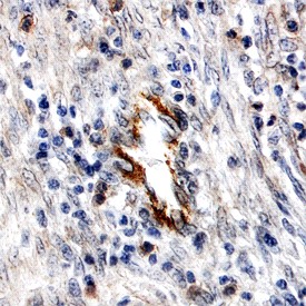 DDR1 in Human Breast Cancer Tissue. DDR1 was detected in immersion fixed paraffin-embedded sections of human breast cancer tissue using Human DDR1 Antigen Affinity-purified Polyclonal Antibody at 15 ug/ml overnight at 4°C. Before incubation with the primary antibody tissue was subjected to heat-induced epitope retrieval using Antigen Retrieval Reagent-Basic. Tissue was stained using Anti-Goat HRP-DAB (brown) and counterstained with hematoxylin (blue).