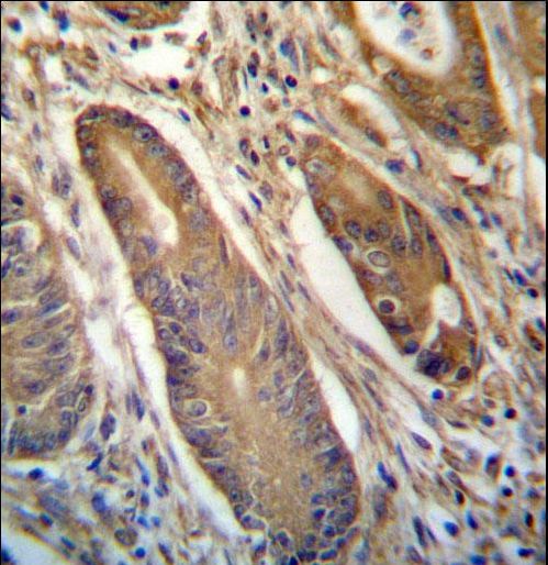 NETO2 Antibody (N-term ) immunohistochemistry of formalin-fixed and paraffin-embedded human colon carcinoma followed by peroxidase-conjugated secondary antibody and DAB staining.