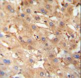 NEU4 antibody immunohistochemistry of formalin-fixed and paraffin-embedded human hepatocarcinoma followed by peroxidase-conjugated secondary antibody and DAB staining.