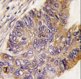 Formalin-fixed and paraffin-embedded human colon carcinoma tissue reacted with RPS6KA1 Antibody (S732), which was peroxidase-conjugated to the secondary antibody, followed by DAB staining. This data demonstrates the use of this antibody for immunohistochemistry; clinical relevance has not been evaluated.