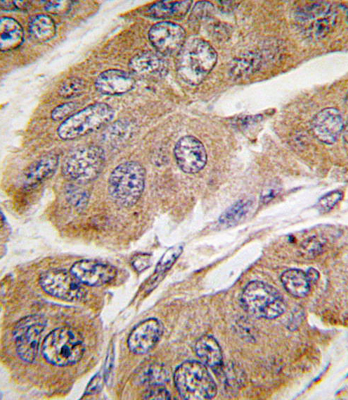 Formalin-fixed and paraffin-embedded human breast carcinoma tissue reacted with RPS6KB1 Antibody (T421) , which was peroxidase-conjugated to the secondary antibody, followed by DAB staining. This data demonstrates the use of this antibody for immunohistochemistry; clinical relevance has not been evaluated.