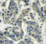 Formalin-fixed and paraffin-embedded human breast carcinoma reacted with RPS6KB1 Antibody , which was peroxidase-conjugated to the secondary antibody, followed by DAB staining. This data demonstrates the use of this antibody for immunohistochemistry; clinical relevance has not been evaluated.