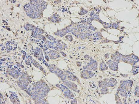 Immunohistochemistry of paraffin-embedded human breast cancer using RRM2 antibody at dilution of 1:200 (200x lens).