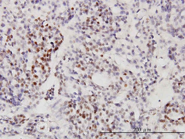 Immunoperoxidase of monoclonal antibody to RNU3IP2 on formalin-fixed paraffin-embedded human ovary, clear cell carcinoma. [antibody concentration 3 ug/ml].