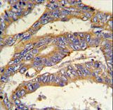 RSAD1 Antibody IHC of formalin-fixed and paraffin-embedded human colon carcinoma followed by peroxidase-conjugated secondary antibody and DAB staining.