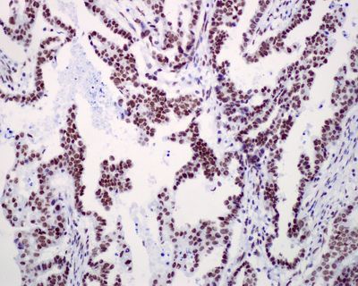 IHC of paraffin-embedded human endometrial adenocarcinoma tissue using anti-Rsf-1 antibody.
