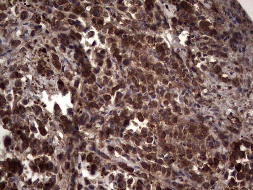IHC of paraffin-embedded Adenocarcinoma of Human breast tissue using anti-RSPO3 mouse monoclonal antibody. (Heat-induced epitope retrieval by 1 mM EDTA in 10mM Tris, pH8.5, 120°C for 3min).