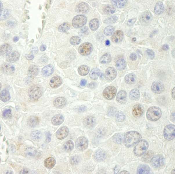 Detection of Mouse Rtf1 by Immunohistochemistry. Sample: FFPE section of mouse renal cell carcinoma. Antibody: Affinity purified rabbit anti-Rtf1 used at a dilution of 1:250.