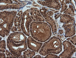IHC of paraffin-embedded Carcinoma of Human thyroid tissue using anti-RTKN mouse monoclonal antibody.