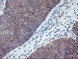 IHC of paraffin-embedded Carcinoma of Human bladder tissue using anti-RTN4IP1 mouse monoclonal antibody. (Heat-induced epitope retrieval by 10mM citric buffer, pH6.0, 100C for 10min).
