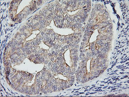 IHC of paraffin-embedded Adenocarcinoma of Human endometrium tissue using anti-RTN4IP1 mouse monoclonal antibody. (Heat-induced epitope retrieval by 10mM citric buffer, pH6.0, 100C for 10min).