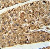 RT4I1 Antibody immunohistochemistry of formalin-fixed and paraffin-embedded human hepatocarcinoma followed by peroxidase-conjugated secondary antibody and DAB staining.