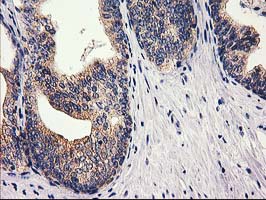IHC of paraffin-embedded Carcinoma of Human prostate tissue using anti-RTN4IP1 mouse monoclonal antibody.