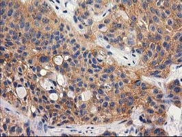 IHC of paraffin-embedded Carcinoma of Human bladder tissue using anti-RTN4IP1 mouse monoclonal antibody.