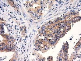 IHC of paraffin-embedded Adenocarcinoma of Human colon tissue using anti-RTN4IP1 mouse monoclonal antibody.