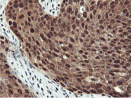IHC of paraffin-embedded Carcinoma of Human bladder tissue using anti-PSMB7 mouse monoclonal antibody.