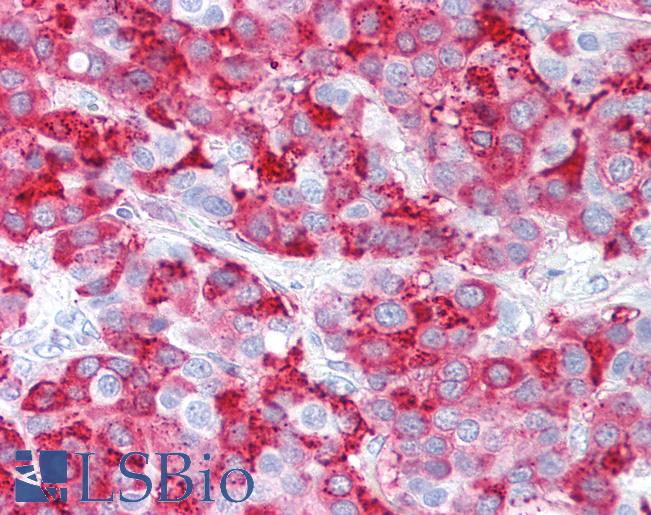 Anti-RXFP1/ LGR7 antibody IHC of human Breast, Carcinoma. Immunohistochemistry of formalin-fixed, paraffin-embedded tissue after heat-induced antigen retrieval.