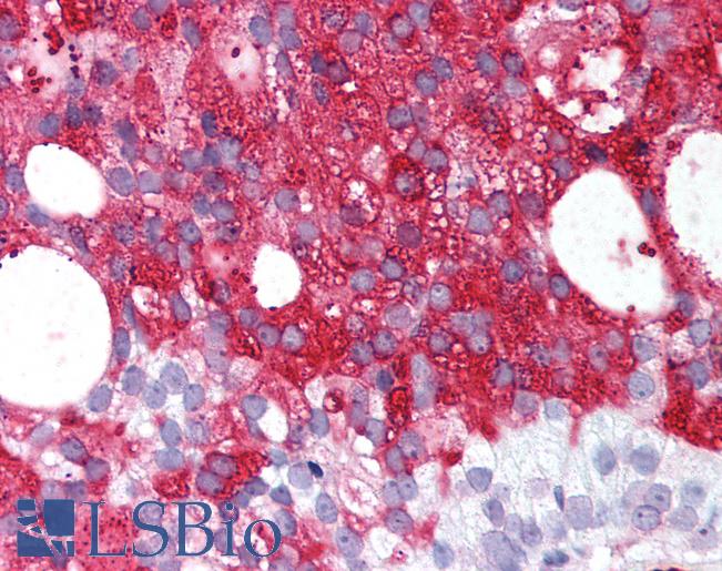 Anti-RXFP1/ LGR7 antibody IHC of human Prostate, Carcinoma. Immunohistochemistry of formalin-fixed, paraffin-embedded tissue after heat-induced antigen retrieval.