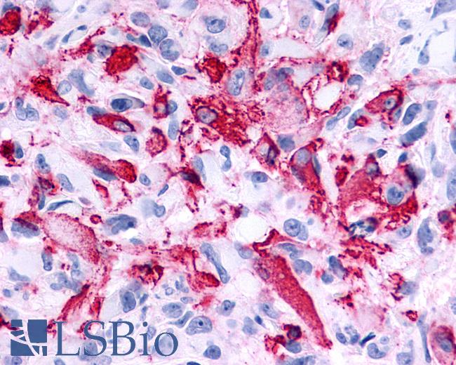 Anti-RXFP2 / LGR8 antibody IHC of human Brain, Glioblastoma. Immunohistochemistry of formalin-fixed, paraffin-embedded tissue after heat-induced antigen retrieval.