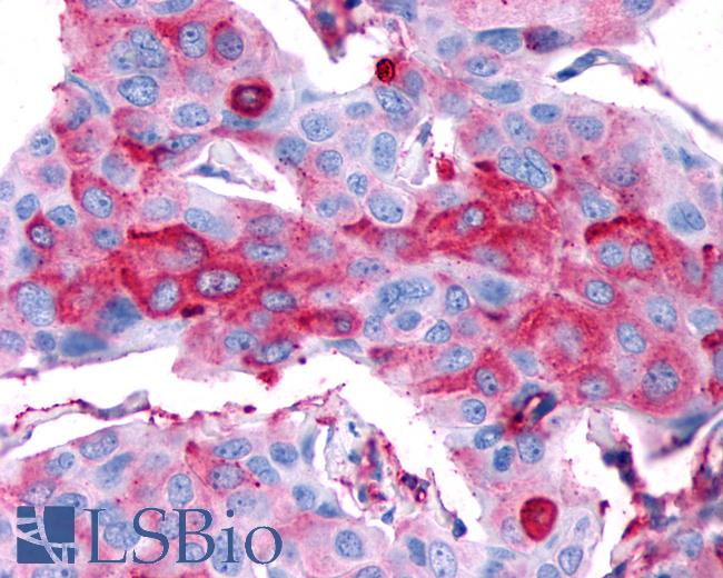 Anti-RXFP2 / LGR8 antibody IHC of human Breast, Carcinoma. Immunohistochemistry of formalin-fixed, paraffin-embedded tissue after heat-induced antigen retrieval.