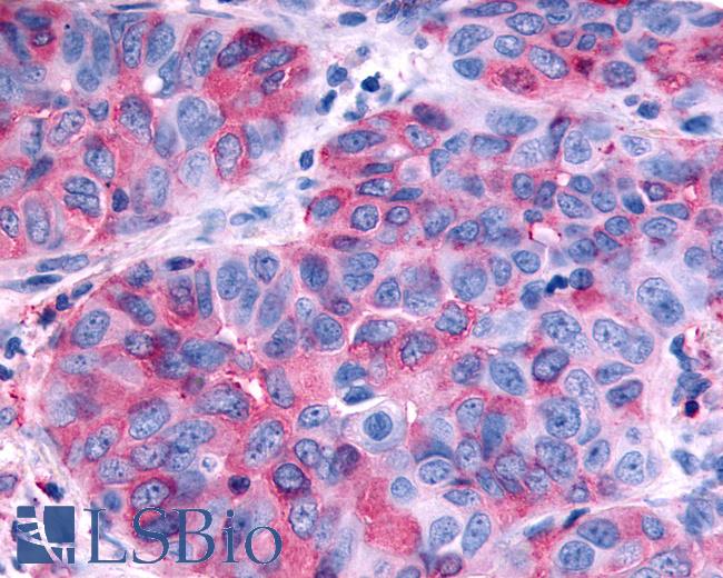 Anti-RXFP2 / LGR8 antibody IHC of human Lung, Non-Small Cell Carcinoma. Immunohistochemistry of formalin-fixed, paraffin-embedded tissue after heat-induced antigen retrieval.