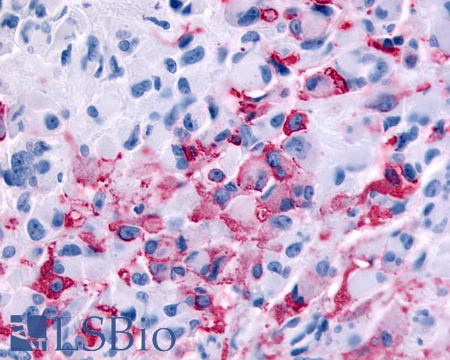 Anti-RXFP2 / LGR8 antibody IHC of human Brain, Glioblastoma. Immunohistochemistry of formalin-fixed, paraffin-embedded tissue after heat-induced antigen retrieval.