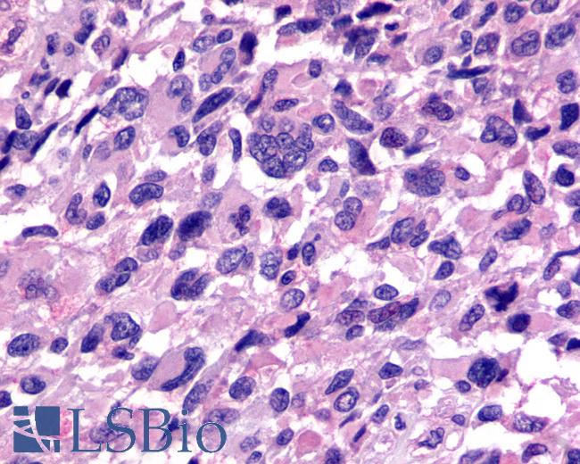 Anti-RXFP3 antibody IHC of human Brain, Glioblastoma. Immunohistochemistry of formalin-fixed, paraffin-embedded tissue after heat-induced antigen retrieval.