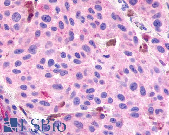 Anti-RXFP3 antibody IHC of human Skin, Melanoma. Immunohistochemistry of formalin-fixed, paraffin-embedded tissue after heat-induced antigen retrieval.