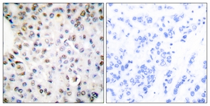 IHC of paraffin-embedded human breast carcinoma tissue, using Retinoid X Receptor gamma Antibody. The picture on the right is treated with the synthesized peptide.
