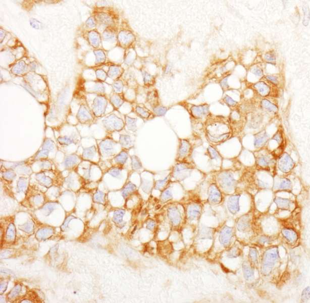 Detection of Human RCN1 by Immunohistochemistry. Sample: FFPE section of human breast carcinoma. Antibody: Affinity purified rabbit anti-RCN1 used at a dilution of 1:1000 (1 ug/ml). Detection: DAB.