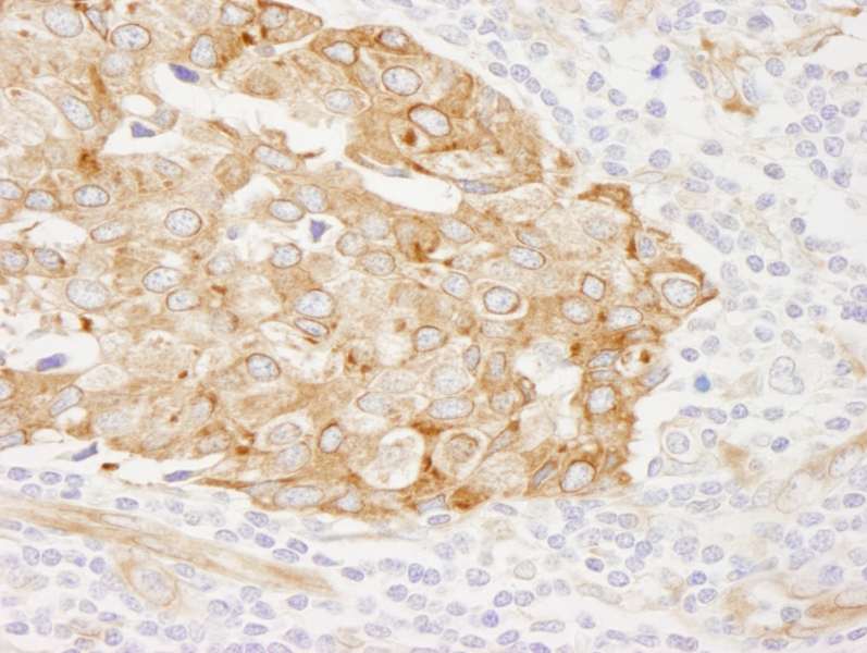 Detection of Human Reticulocalbin by Immunohistochemistry. Sample: FFPE section of human breast carcinoma. Antibody: Affinity purified rabbit anti-Reticulocalbin used at a dilution of 1:250.