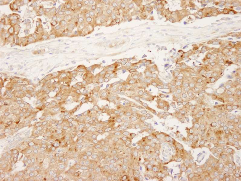 Detection of Human Reticulocalbin by Immunohistochemistry. Sample: FFPE section of human breast carcinoma. Antibody: Affinity purified rabbit anti-Reticulocalbin used at a dilution of 1:250.