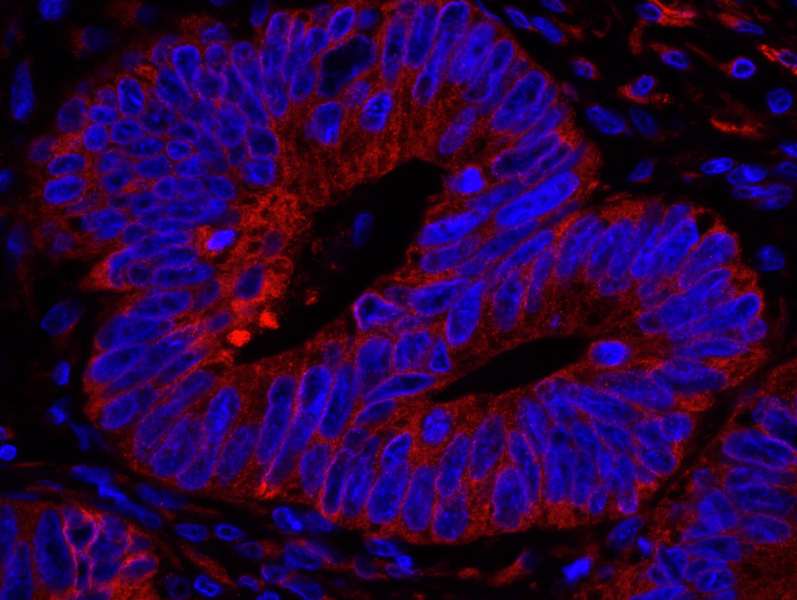 Detection of Human Reticulocalbin by Immunofluorescence. Sample: FFPE section of human breast carcinoma. Antibody: Affinity purified rabbit anti-Reticulocalbin used at a dilution of 1:100. Detection: Red-fluorescent goat anti-rabbit IgG highly cross-adsorbed Antibody.