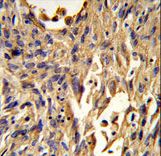 Formalin-fixed and paraffin-embedded human lung carcinoma reacted with S100A10 Antibody , which was peroxidase-conjugated to the secondary antibody, followed by DAB staining. This data demonstrates the use of this antibody for immunohistochemistry; clinical relevance has not been evaluated.