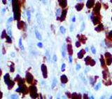 IHC of S100P on FFPE Melanoma tissue.